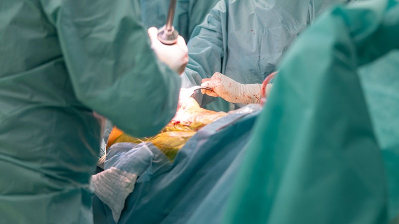 Chirurgen in OP-Kleidung führen eine offene Operation an einem Patienten durch.